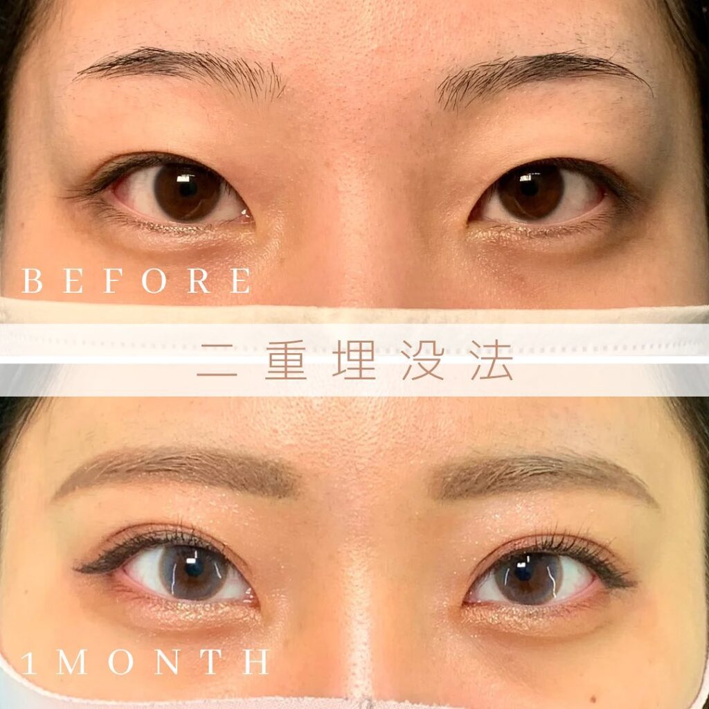 埋没法の症例写真 (13)