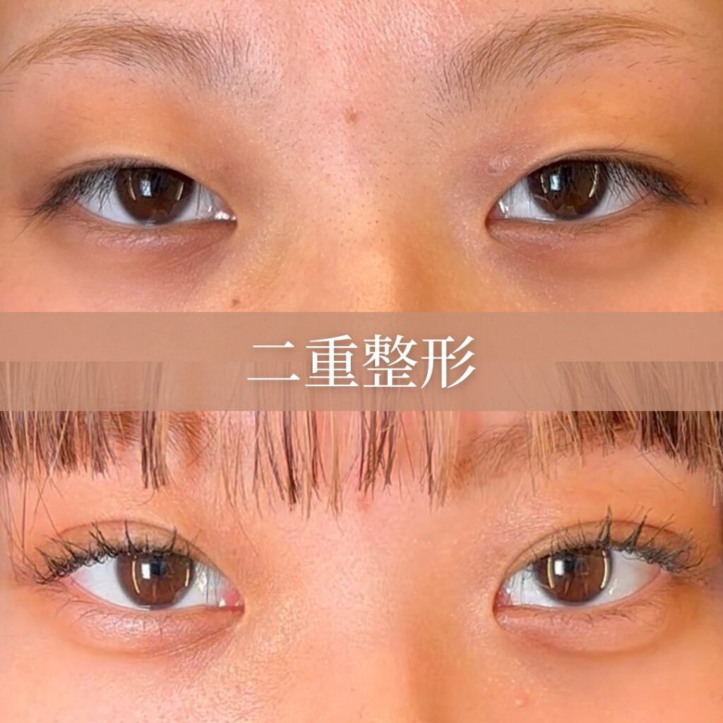 埋没法の症例写真 (5)