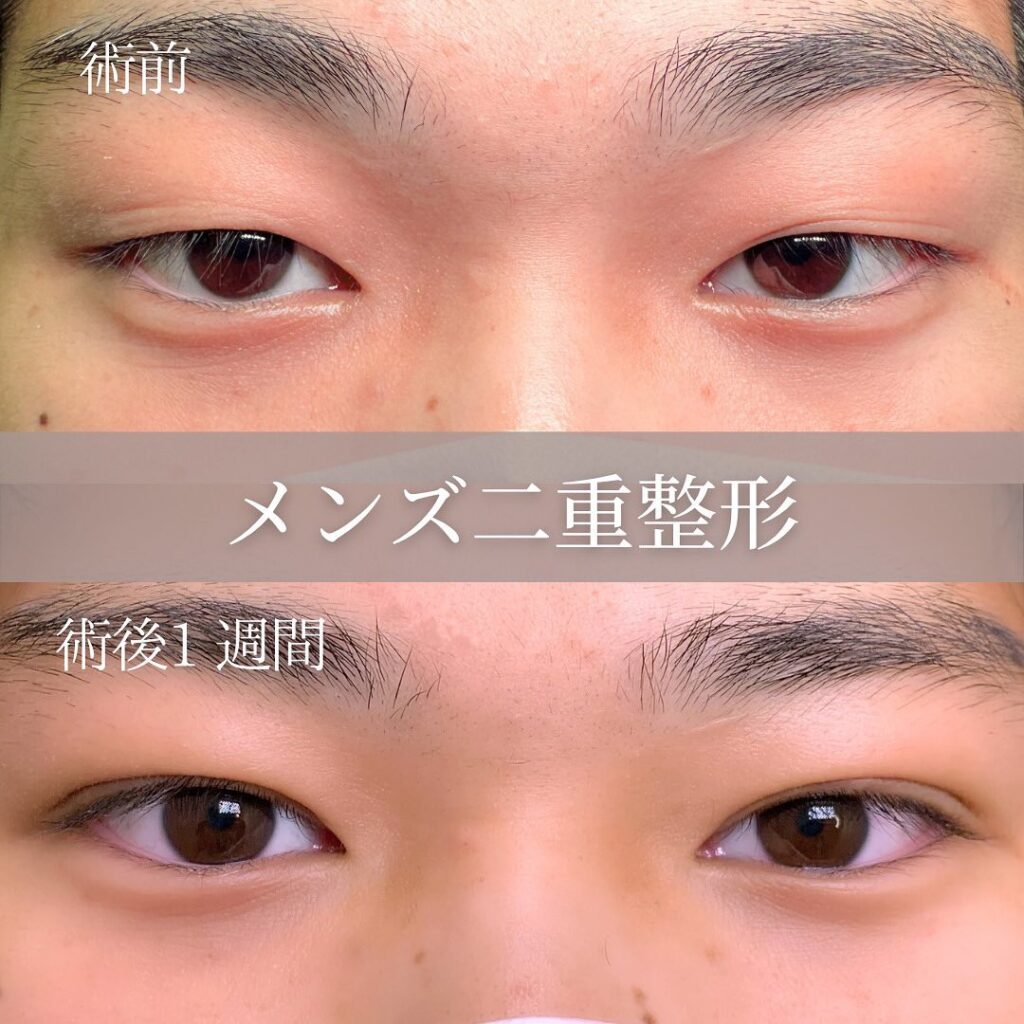 埋没法の症例写真 (7)