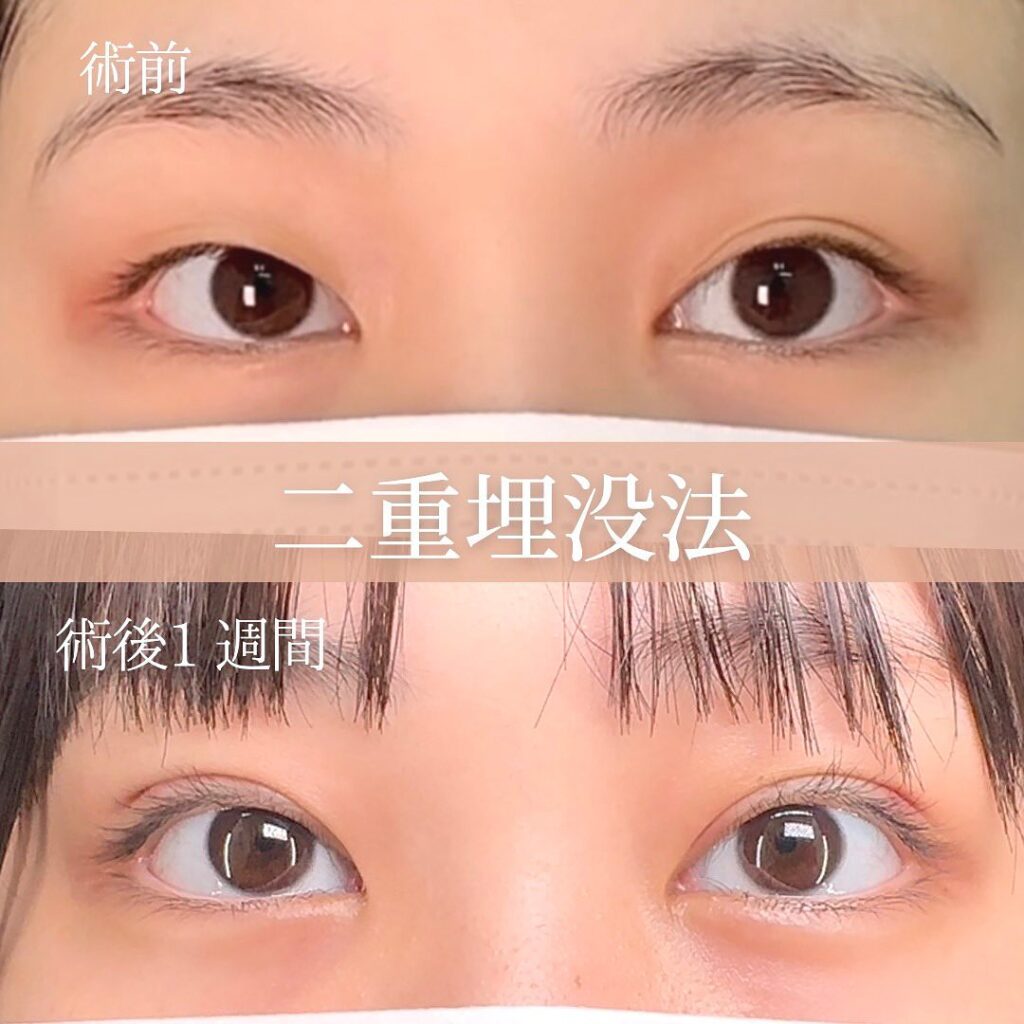 埋没法の症例写真 (8)
