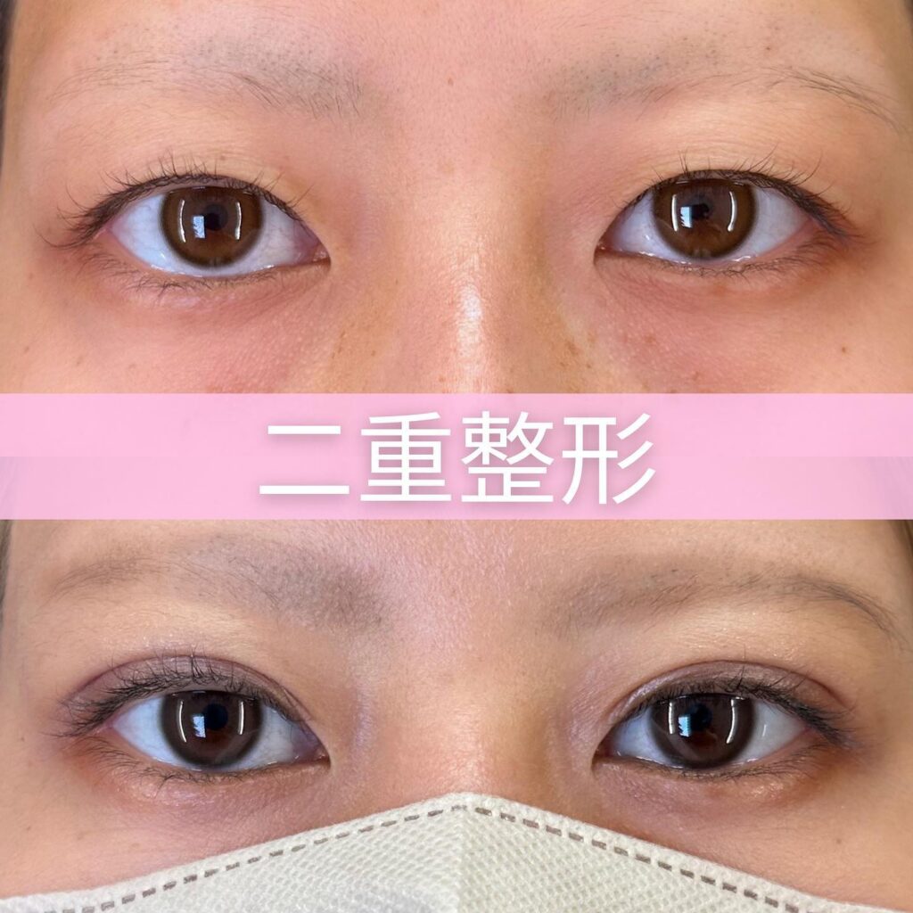 埋没法フォーエバークロス特殊5点留めの症例写真