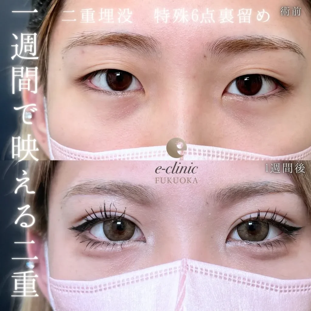 eクリニック福岡院の埋没法特殊6点裏留め(名医の伊藤渉医師が執刀)