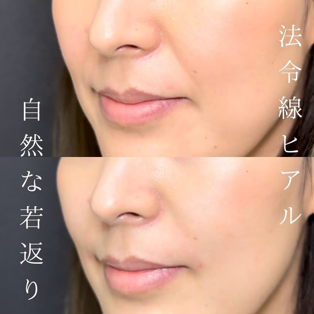 法令線のヒアルロン酸の症例写真