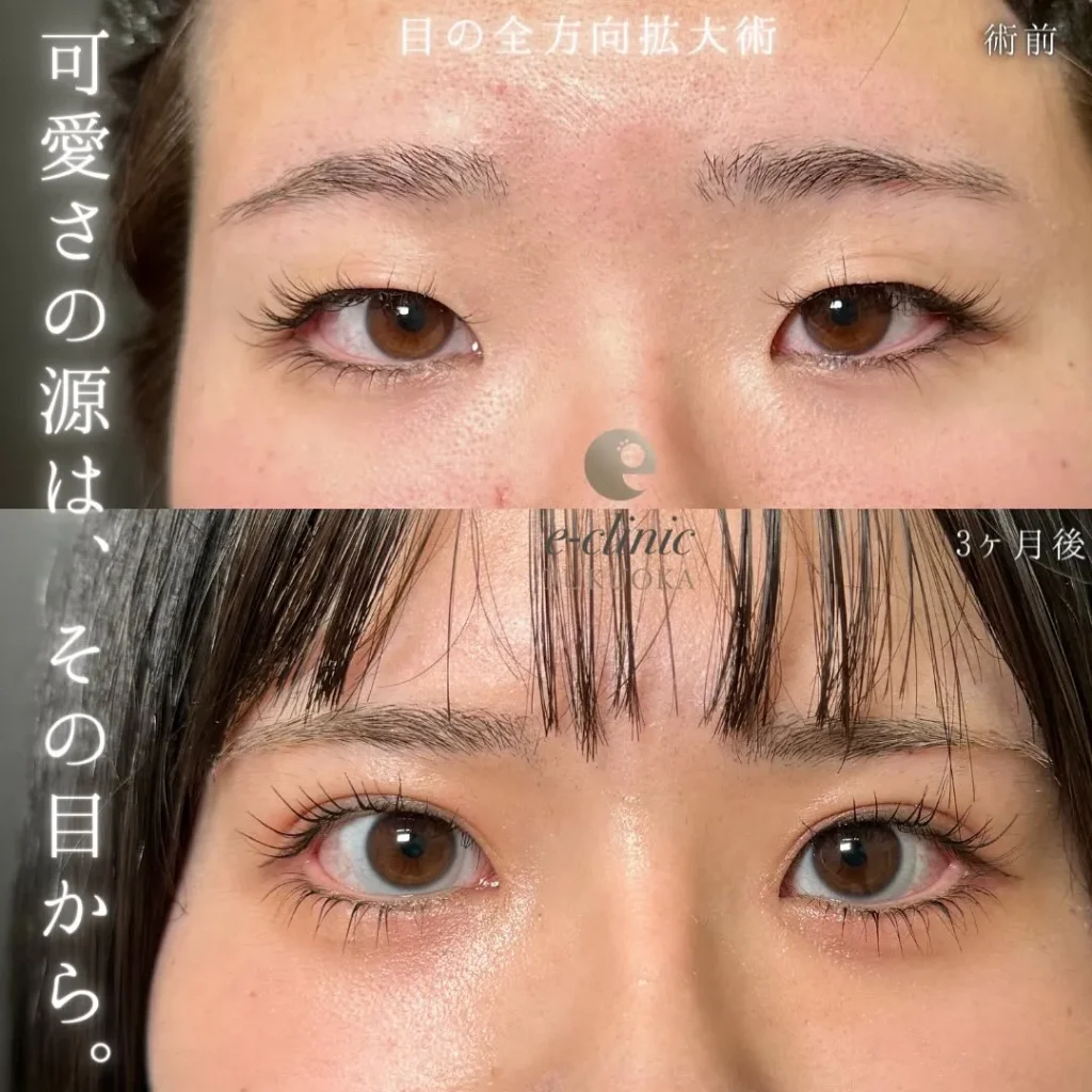 eクリニック福岡院の埋没法特殊6点裏留め+目頭切開+目尻切開+タレ目形成( 皮膚+結膜)(名医の伊藤渉医師が執刀)