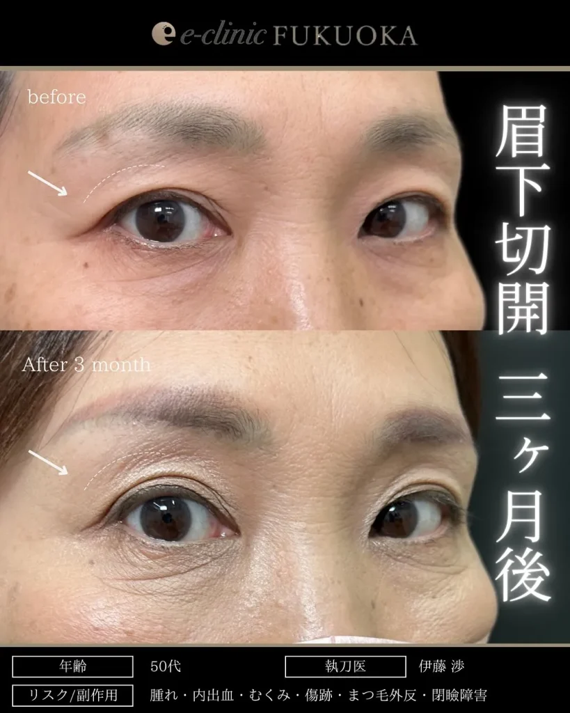 eクリニック福岡院の眉下切開(名医の伊藤渉医師が執刀)