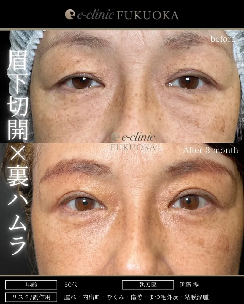 eクリニック福岡院の眉下切開＋裏ハムラ（名医の伊藤渉医師が執刀）