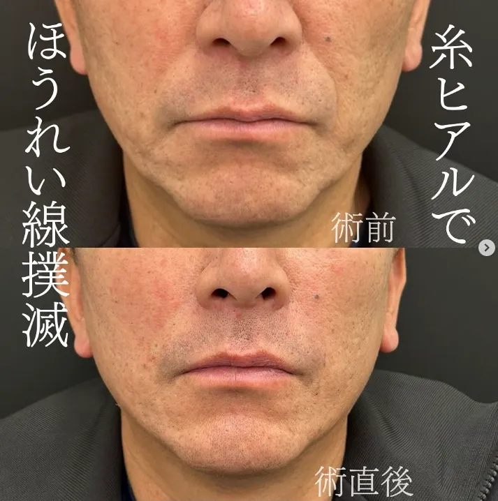 糸リフト 岡山 男性 名医