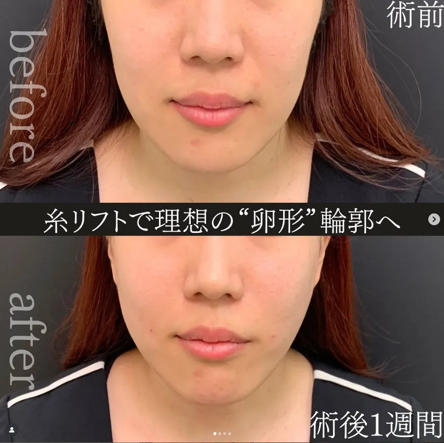 糸リフト 岡山 名医