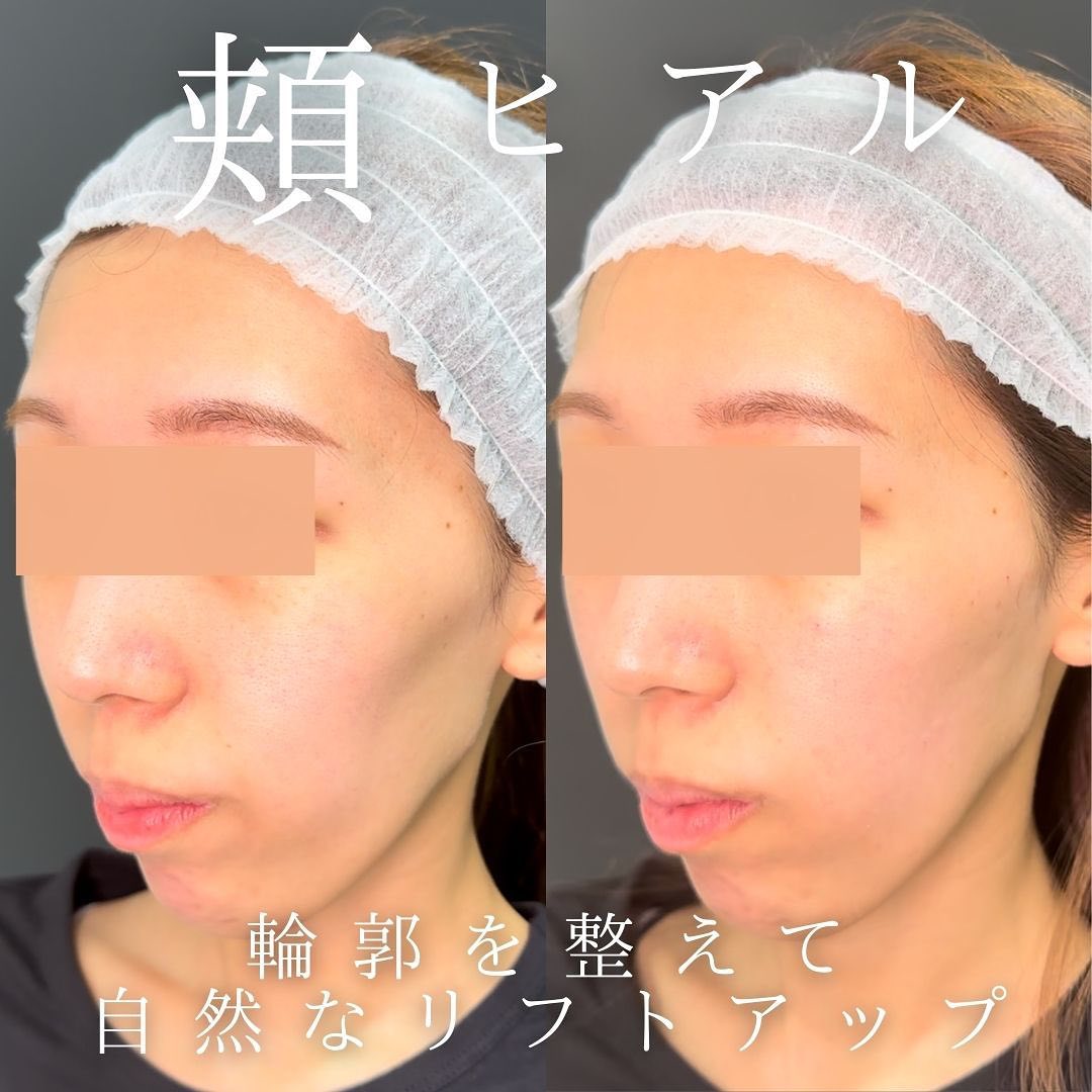 頬のヒアルロン酸の症例写真