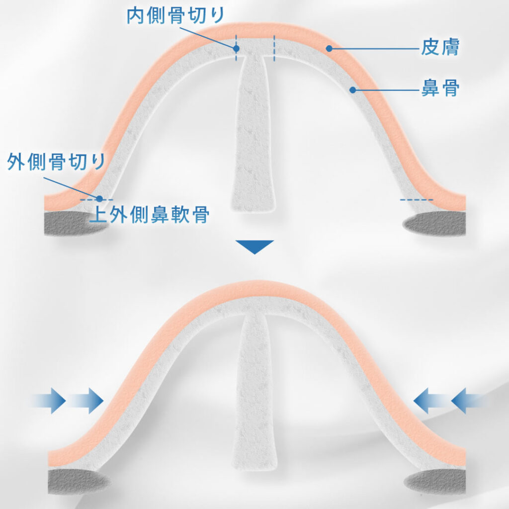 鼻骨骨切りの詳しい解説図
