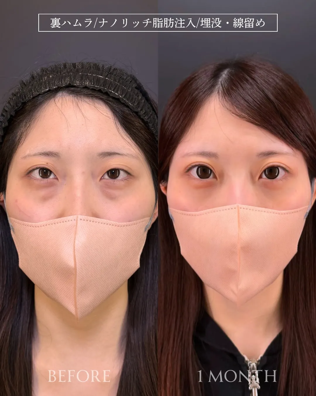 加藤快世医師_コラム用_埋没法（自然癒着？）＋裏ハムラ＋ナノリッチ