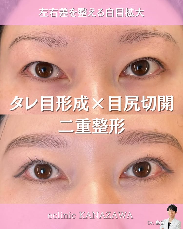 タレ目形成と目尻切開の症例写真