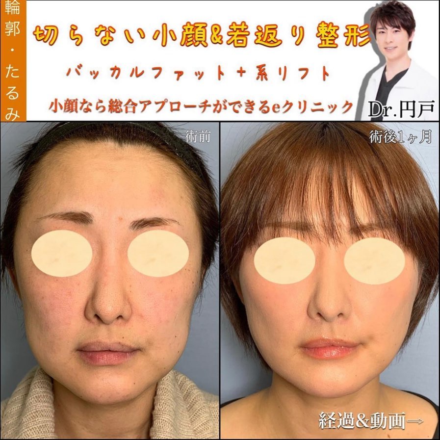 バッカルファットと糸リフトの症例写真 (3)