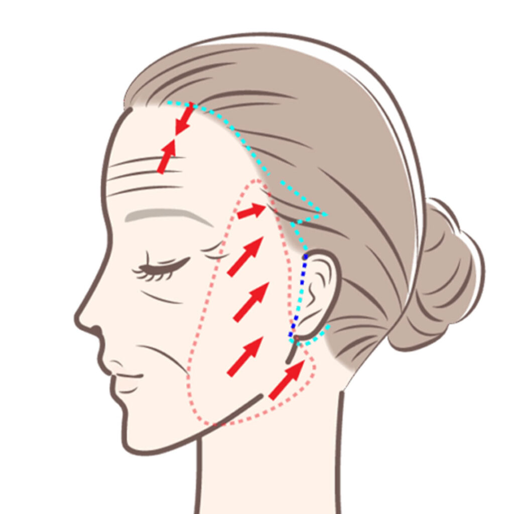 フェイスリフトのイメージ