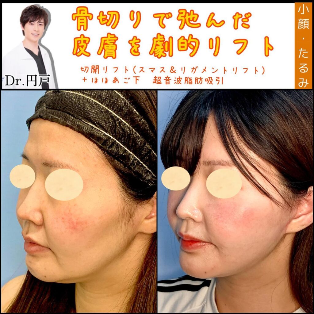 切開リフトと頬顎下の脂肪吸引の症例写真