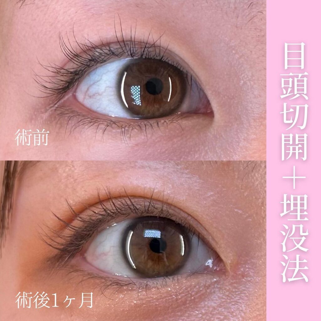 目頭切開と埋没法の症例写真 (1)