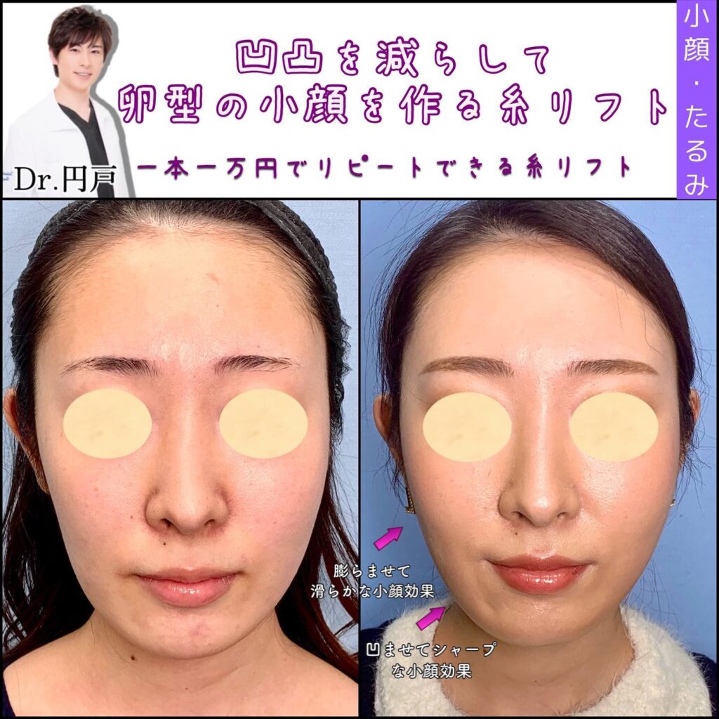 糸リフトの症例写真 (1)