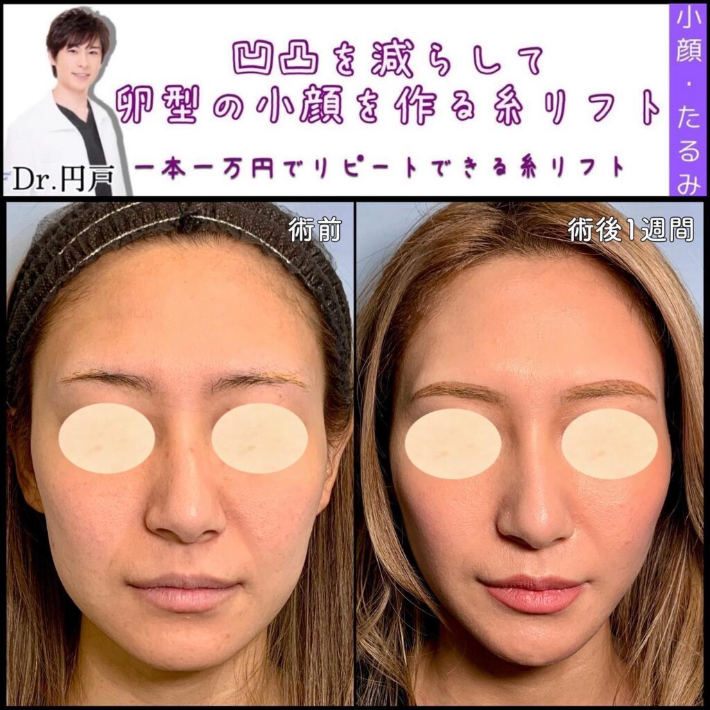 糸リフトの症例写真 (2)