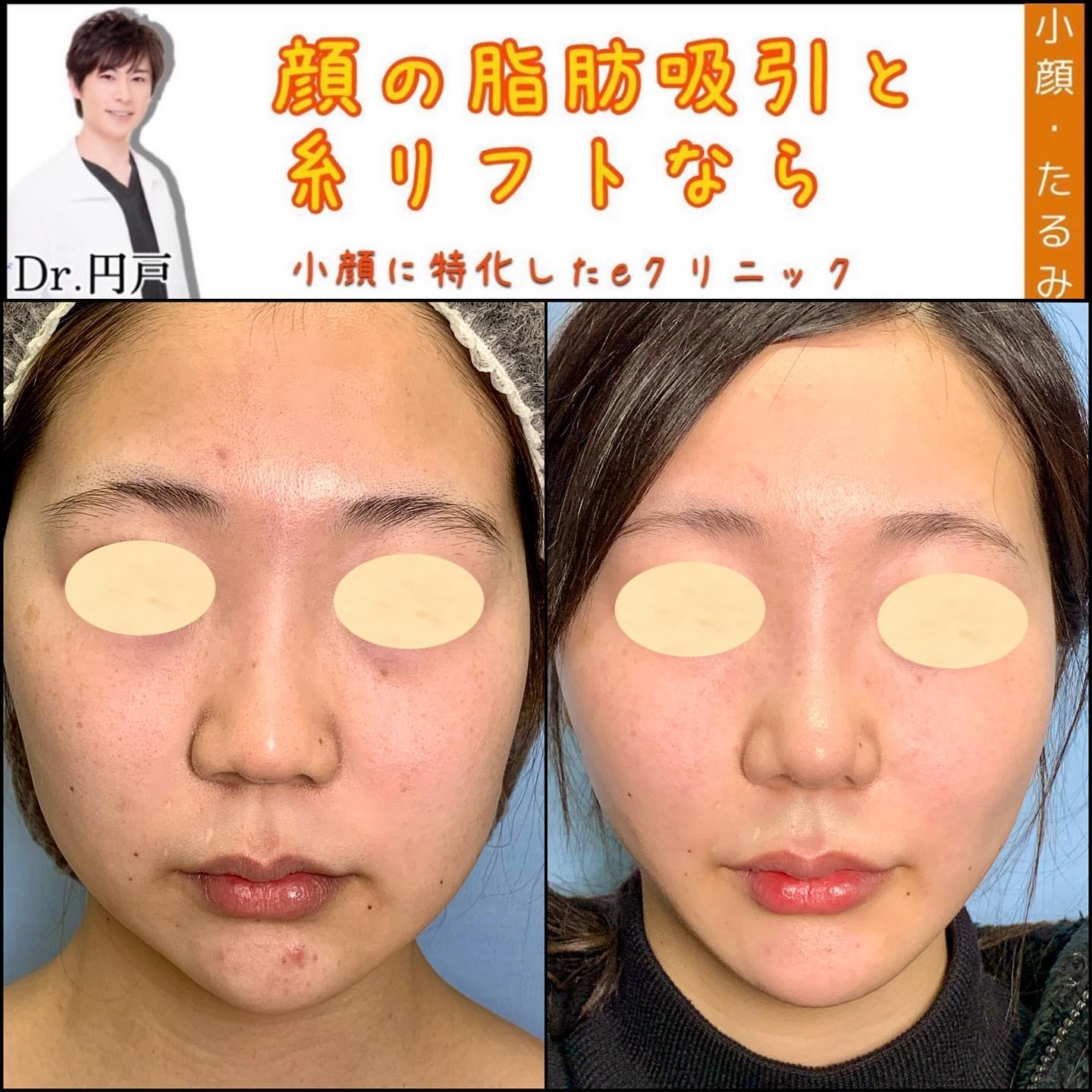 顔の脂肪吸引と糸リフトの症例写真 (1)