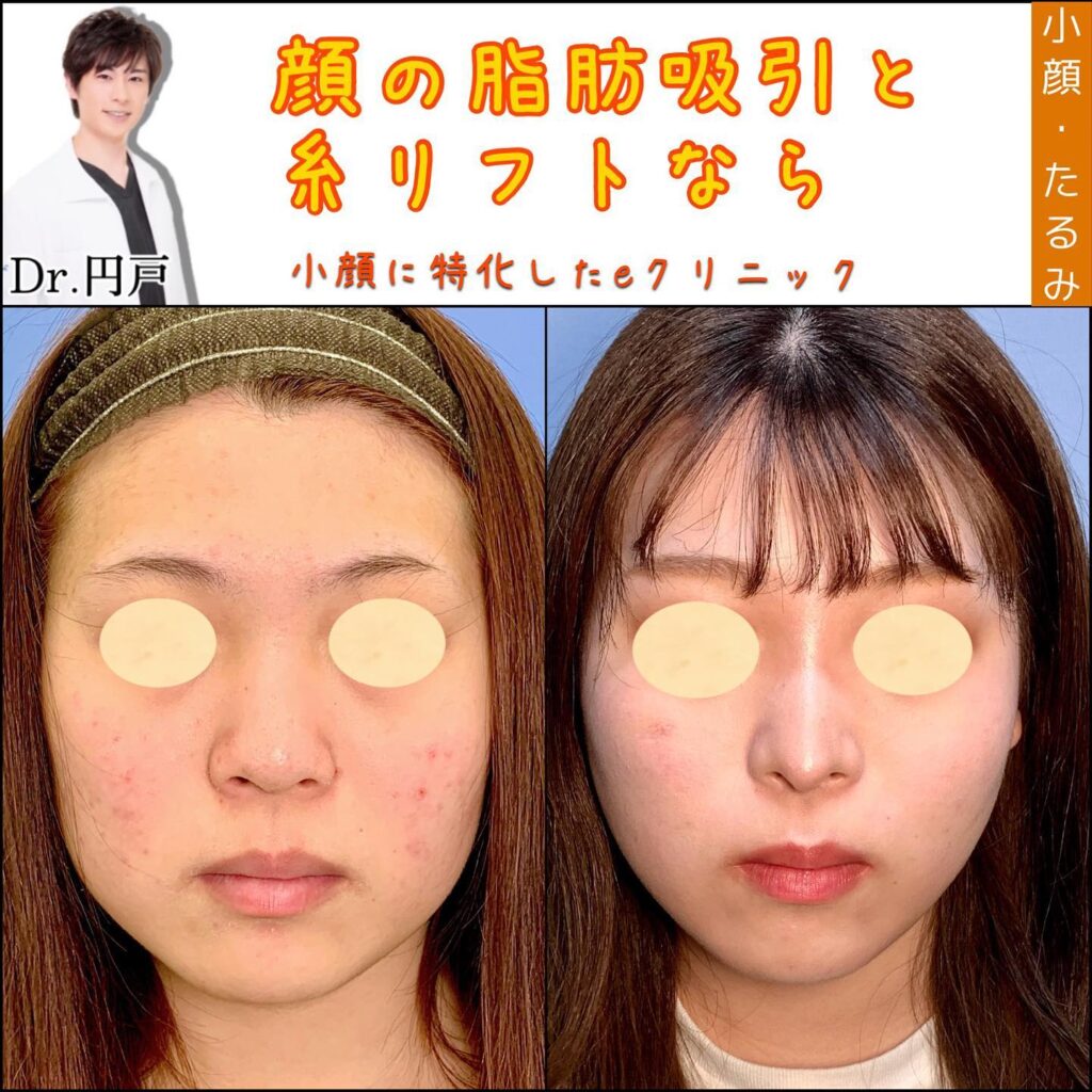 顔の脂肪吸引と糸リフトの症例写真 (4)