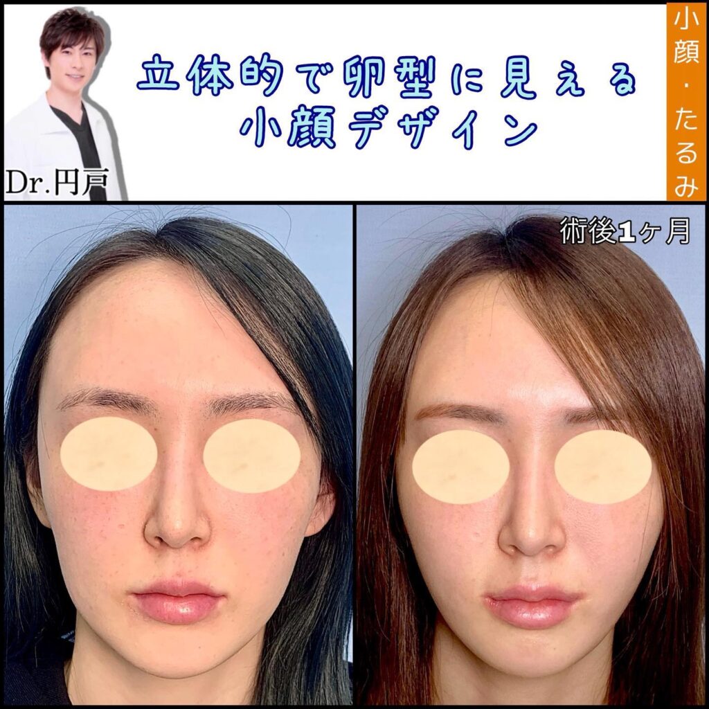 人中短縮と脂肪注入と糸リフトの症例写真 (2)