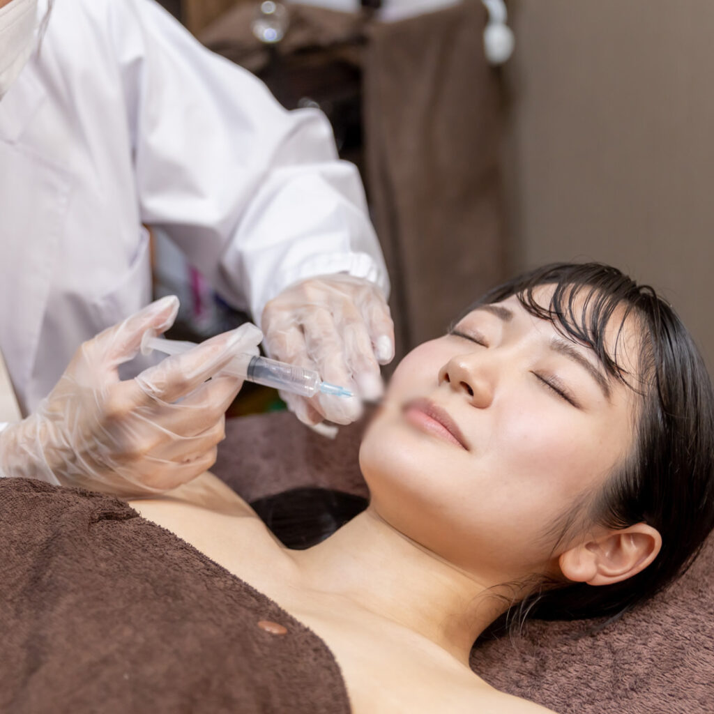 口元のヒアルロン酸注入のイメージ