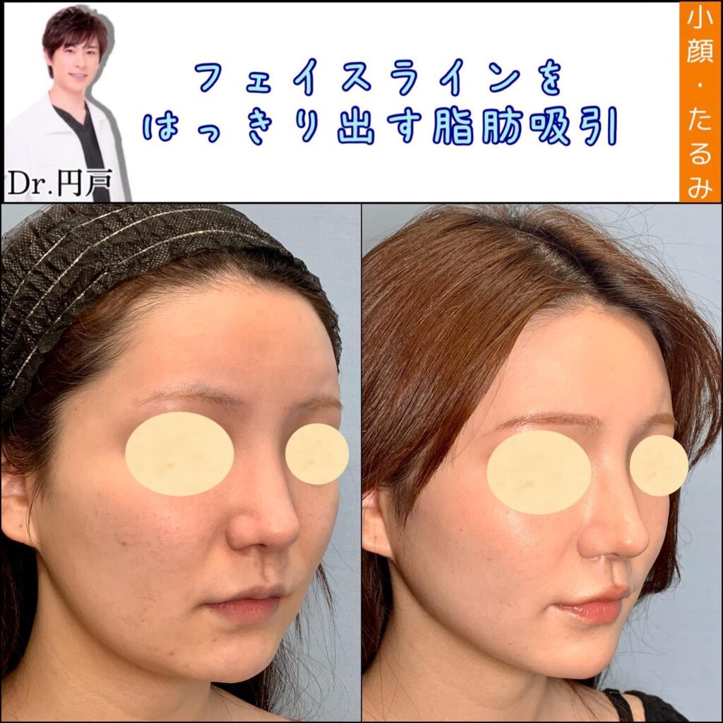 顔の脂肪吸引と糸リフトの症例写真 (13)