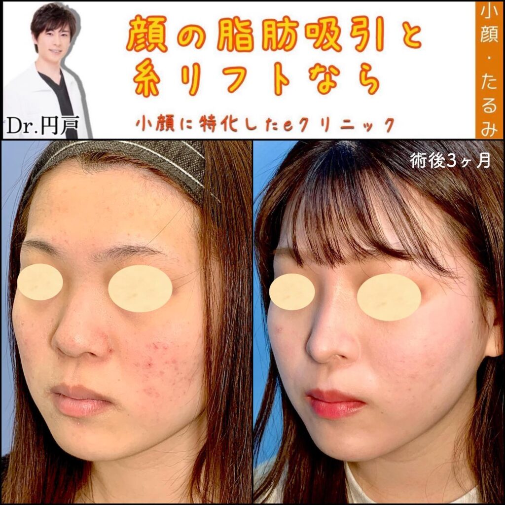 顔の脂肪吸引と糸リフトの症例写真 (9)