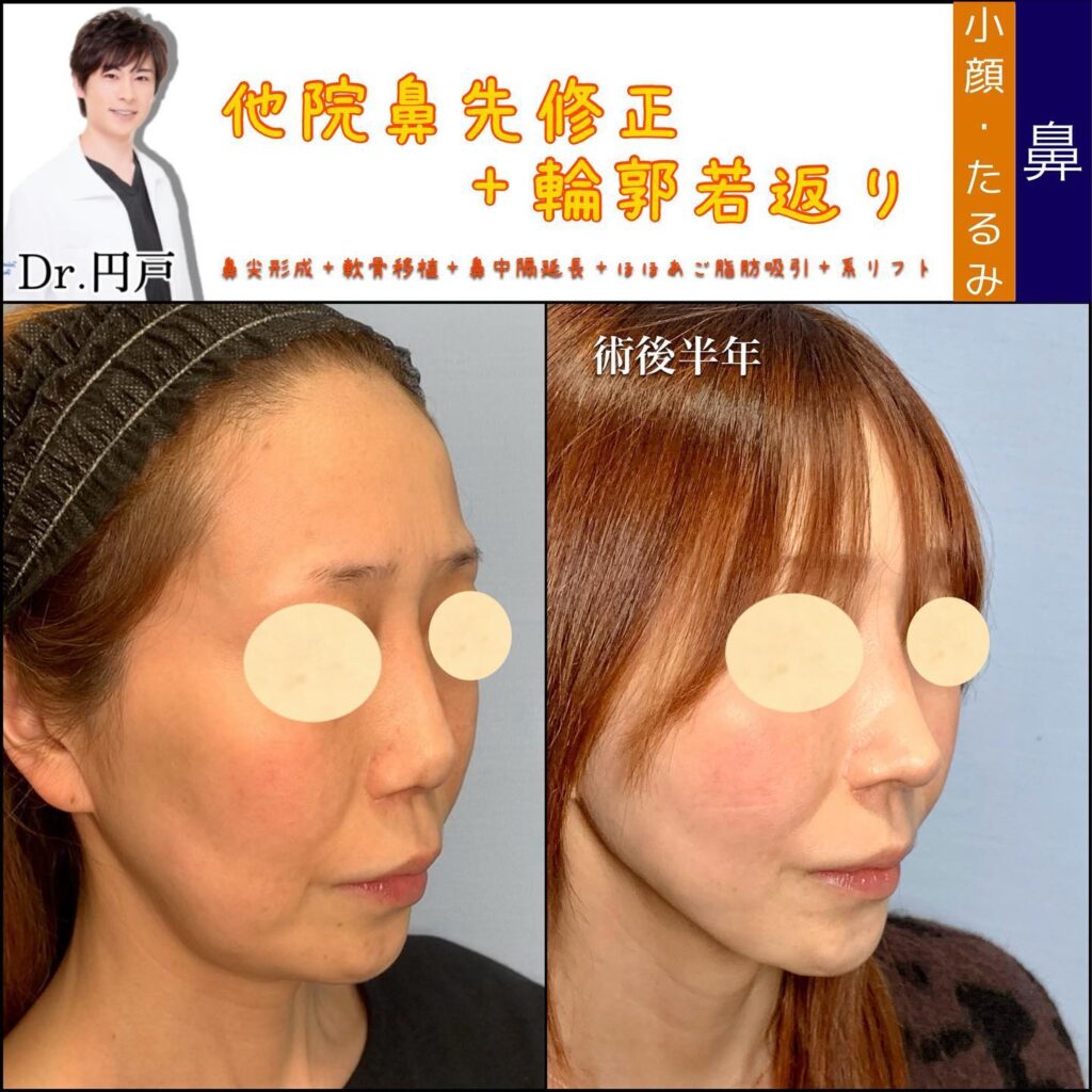 鼻の他院修正と顔の脂肪吸引と糸リフトの症例写真 (2)