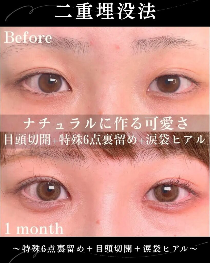 埋没法と目頭切開と涙袋のヒアルロン酸の症例写真