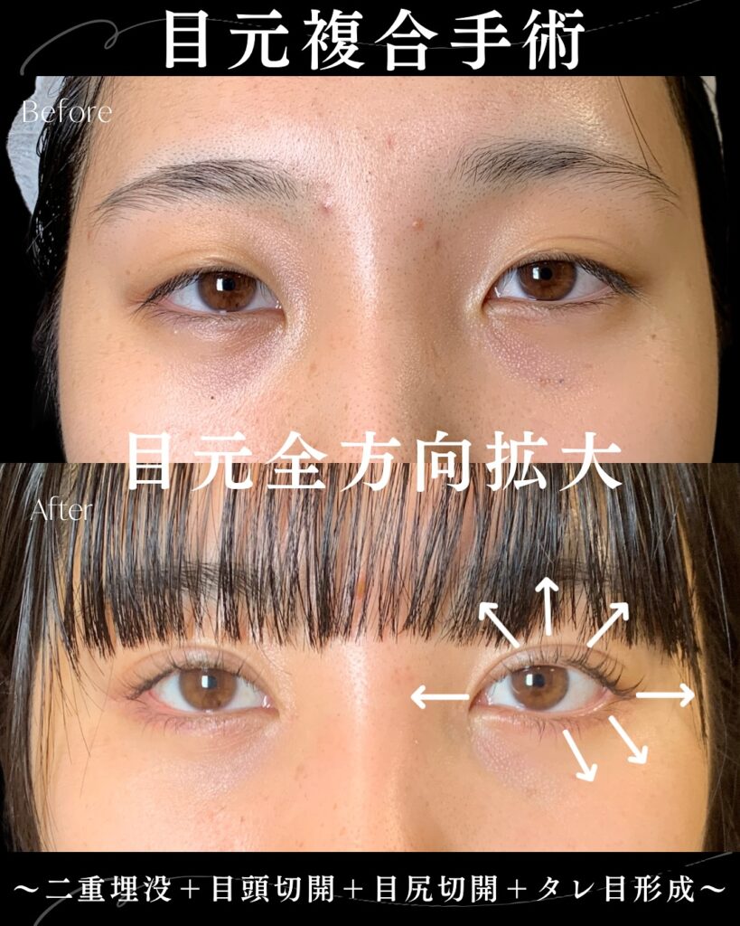 埋没法と目頭切開と目尻切開とタレ目形成の症例写真