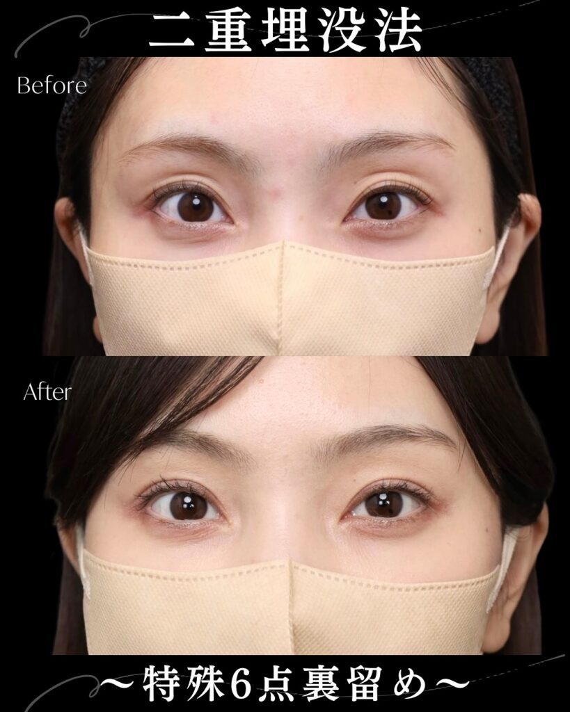 埋没法の症例写真 (19)