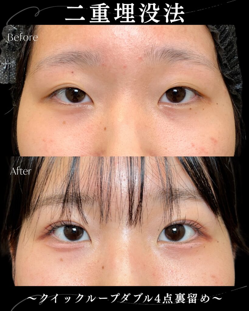 埋没法の症例写真 (24)