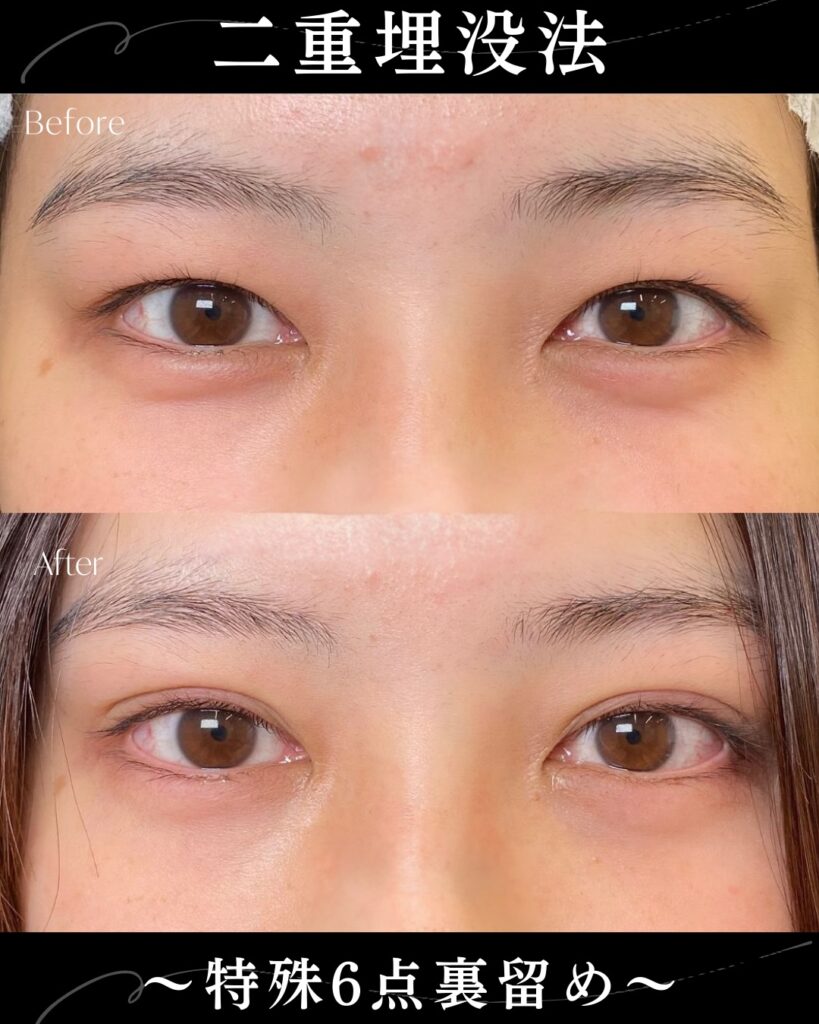 埋没法の症例写真 (25)