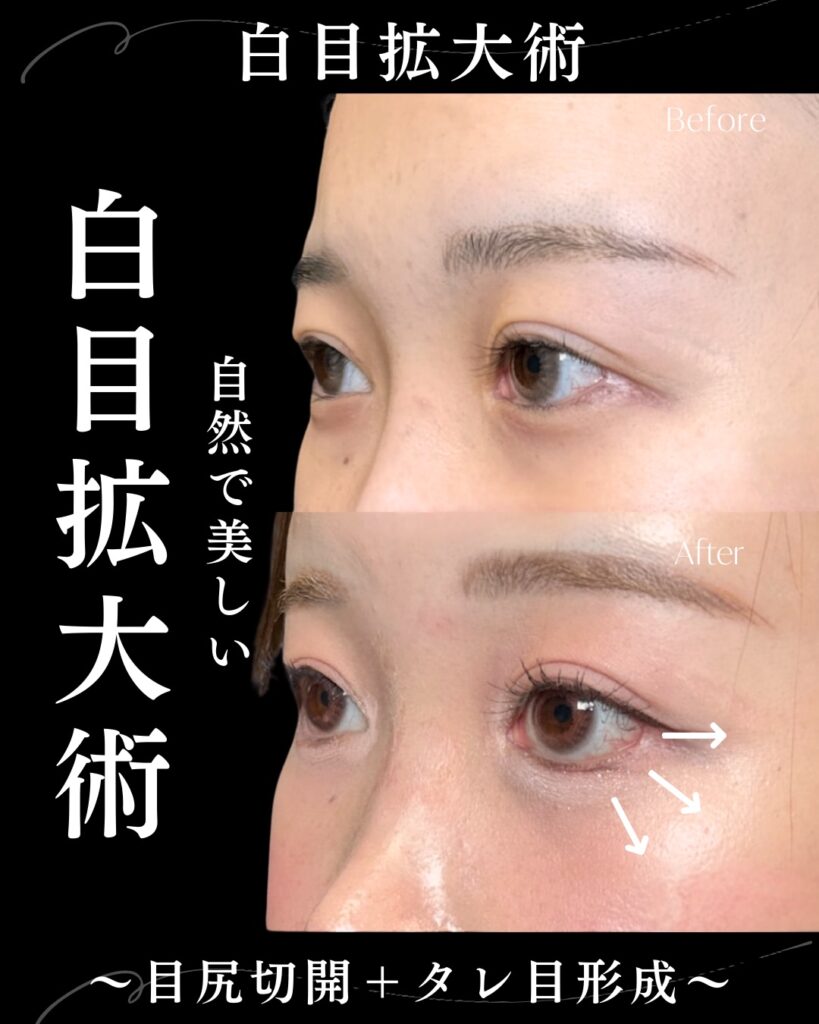 目尻切開とタレ目形成の症例写真 (2)