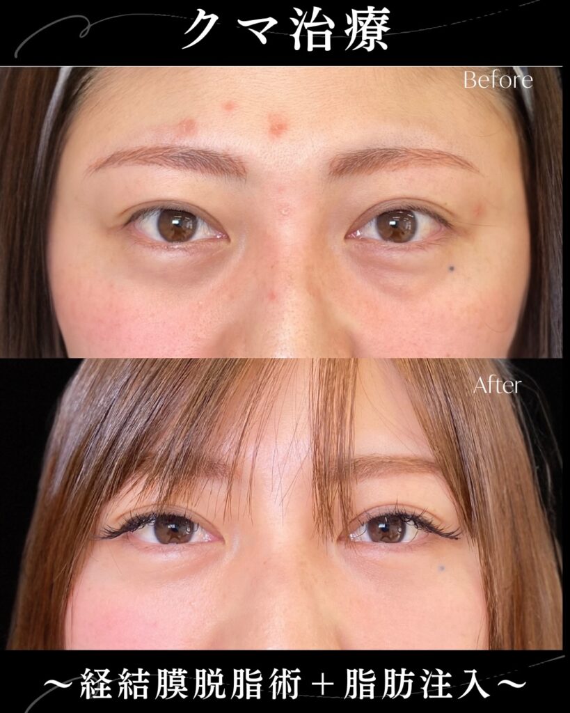 脱脂と脂肪注入の症例写真 (3)