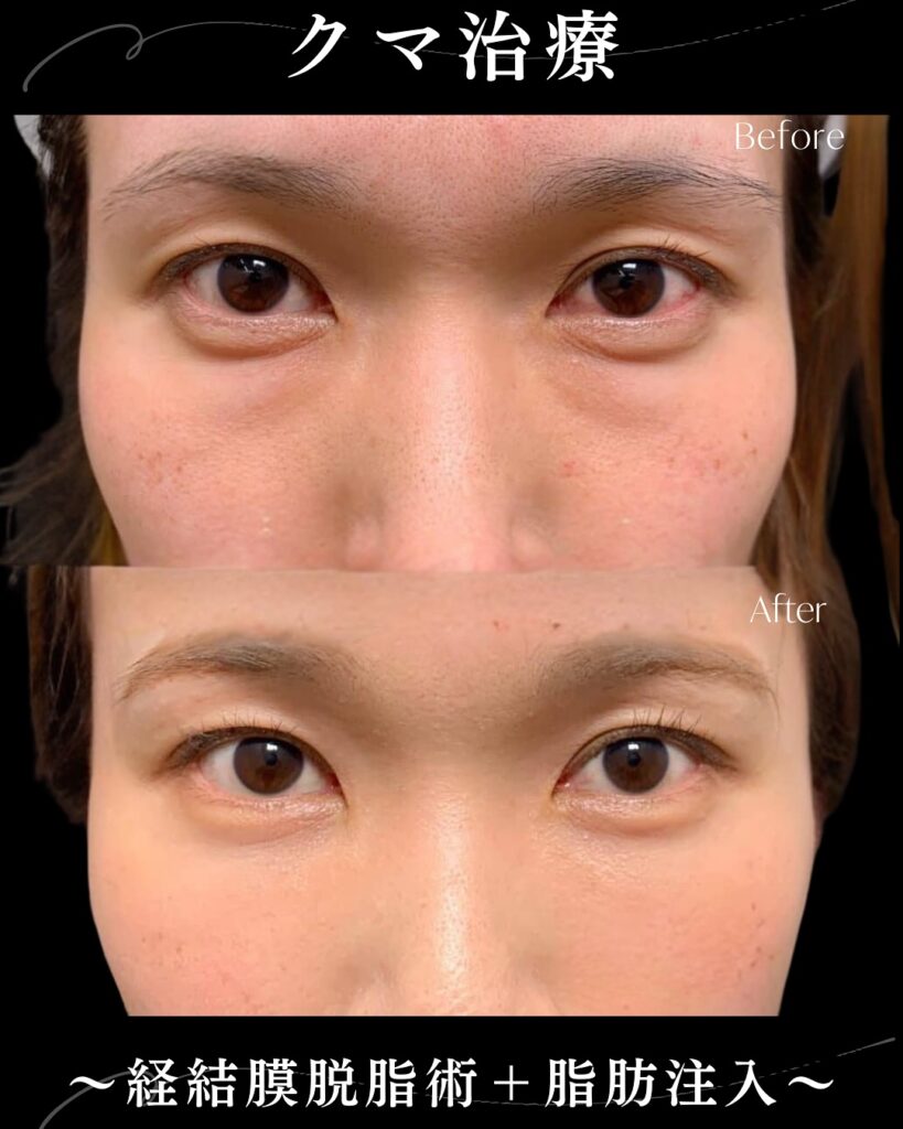 脱脂と脂肪注入の症例写真 (4)