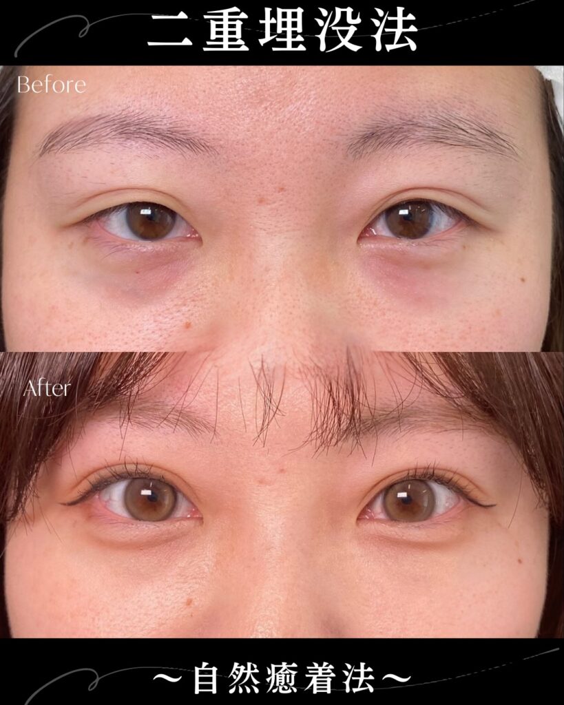 自然癒着法の症例写真 (13)