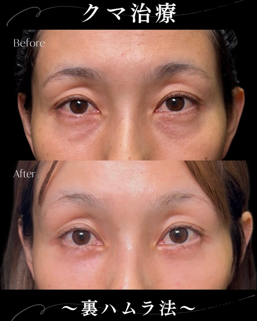 裏ハムラ法の症例写真 (26)