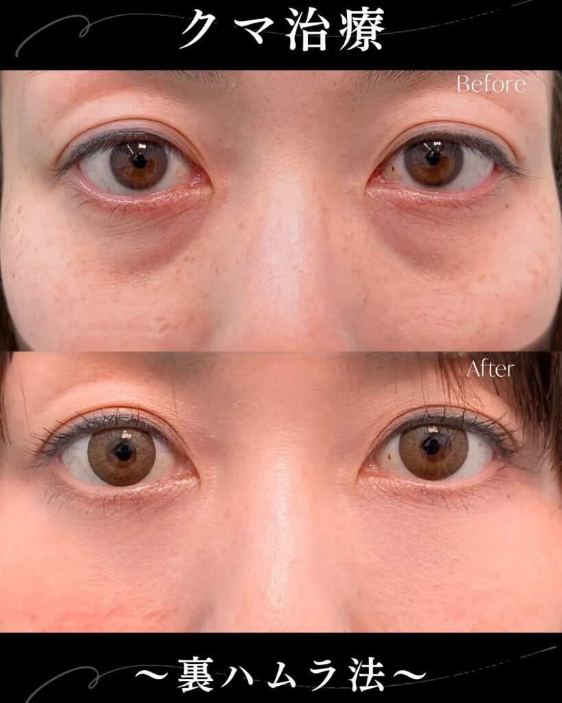 裏ハムラ法の症例写真 (27)