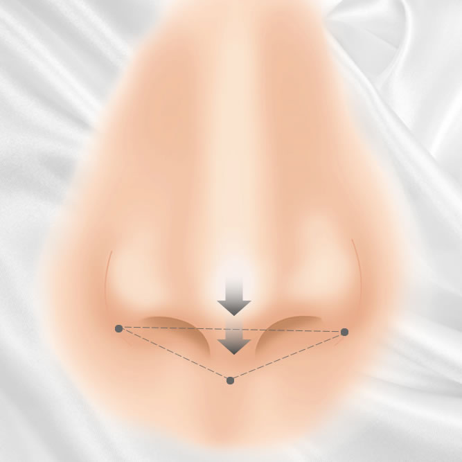 鼻柱下降術のアイコン