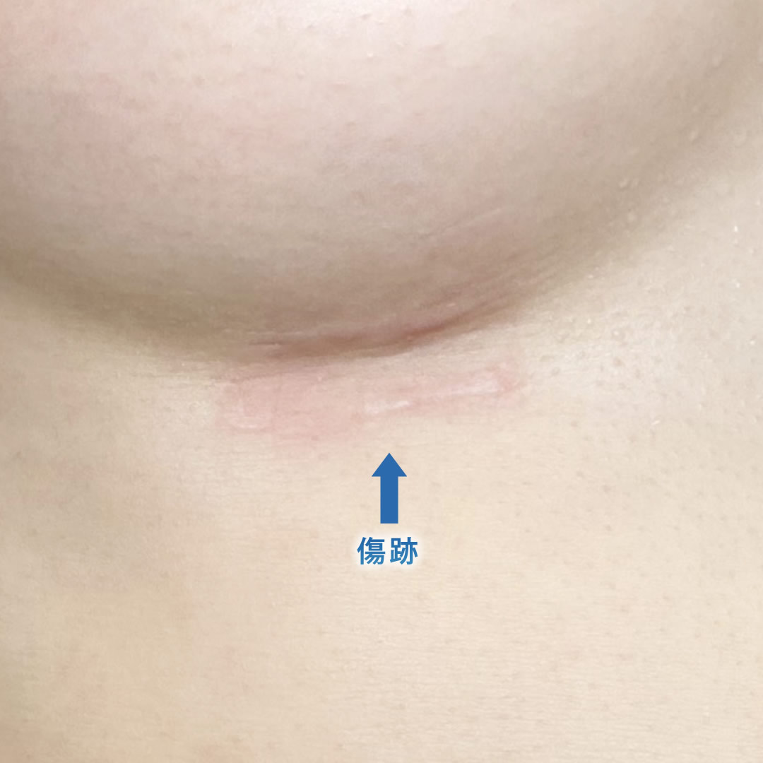 ６ヶ月後の肋軟骨の傷跡