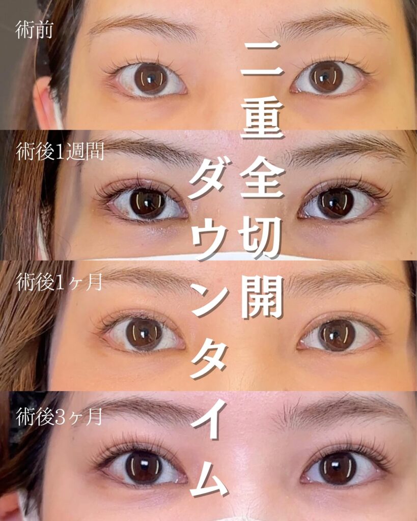 二重全切開の症例写真 (1)
