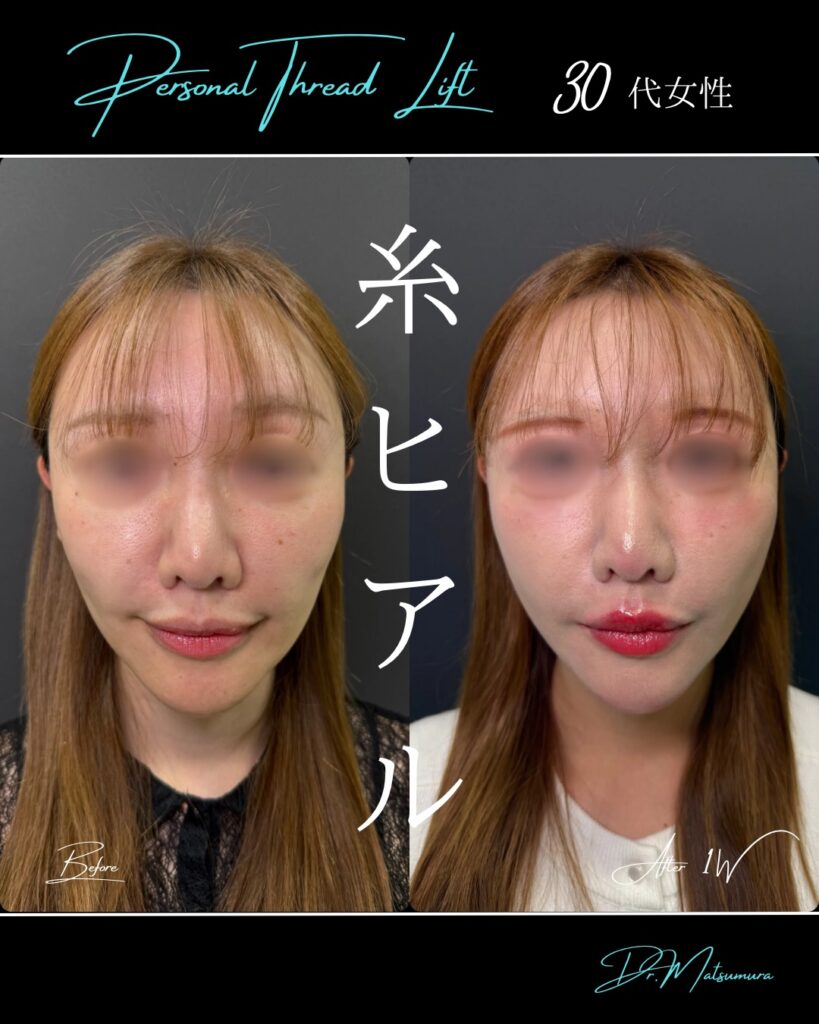 糸リフトとヒアルロン酸の症例写真 (1)