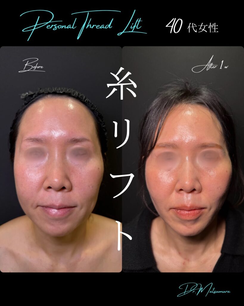 糸リフトの症例写真 (1)