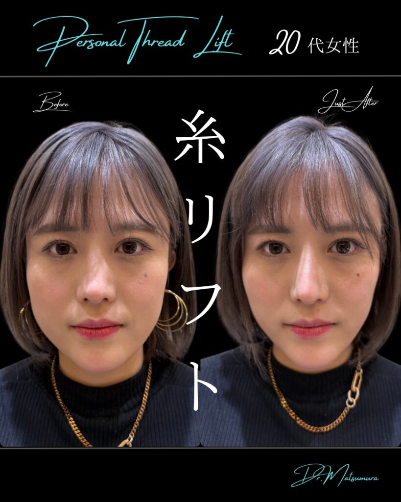 糸リフトの症例写真 (2)