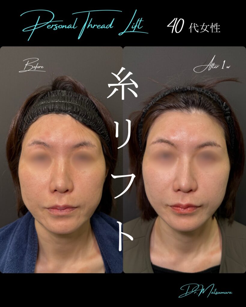 糸リフトの症例写真 (3)