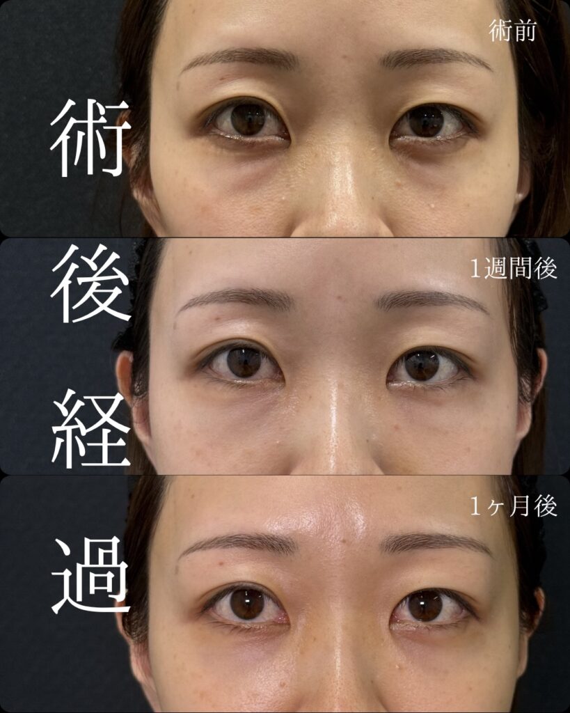 裏ハムラと脂肪注入の症例写真