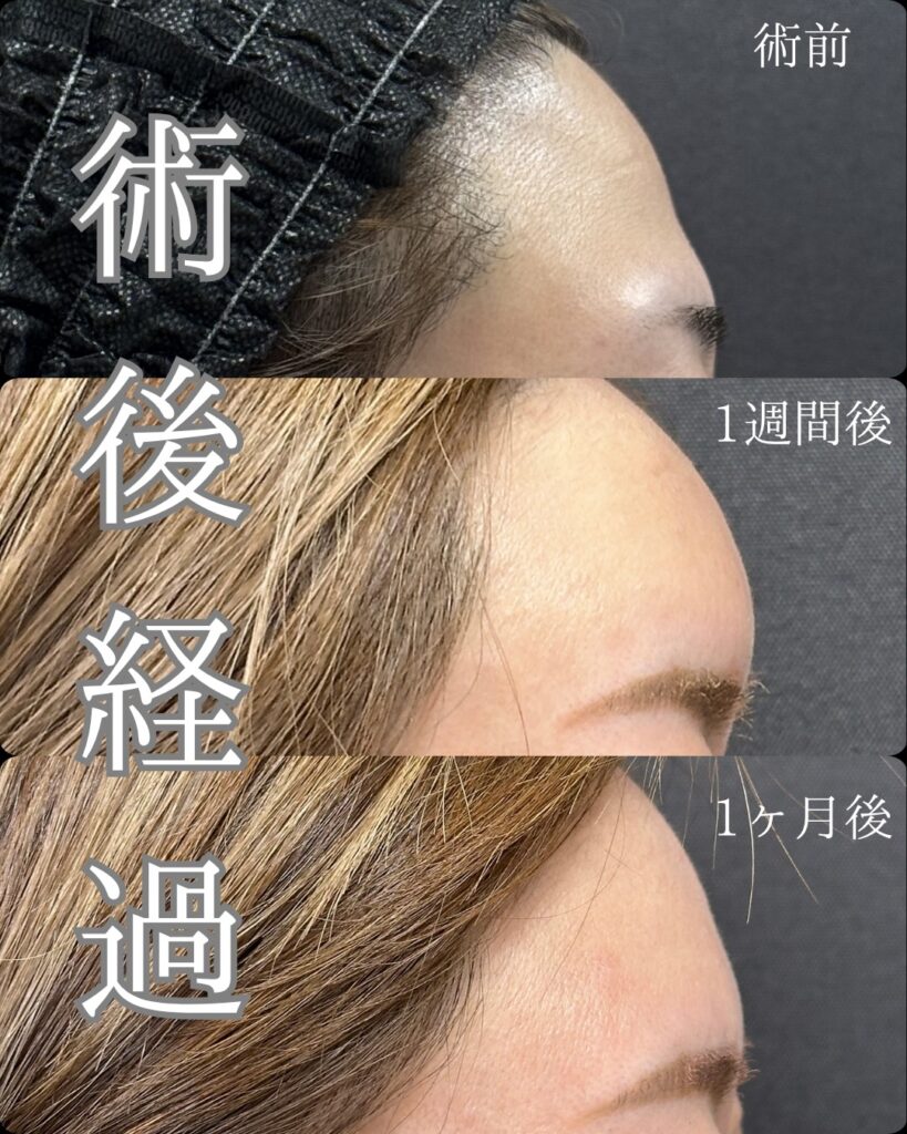 額の脂肪注入の症例写真 (3)