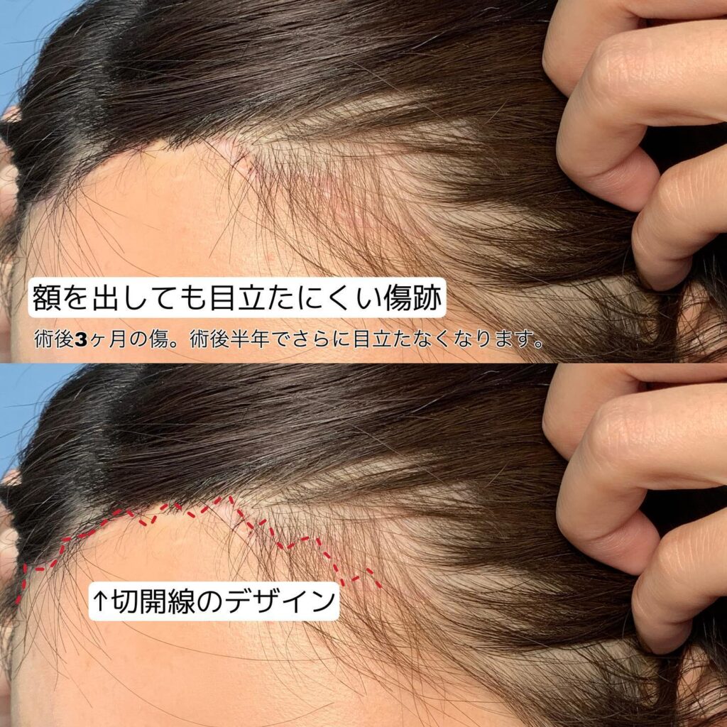 額リフトの症例写真1